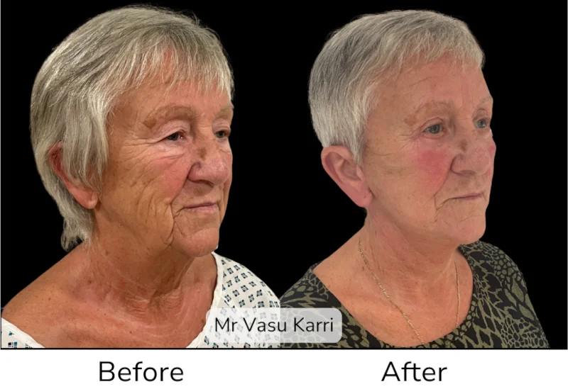 Facelift Patient 10 View 2